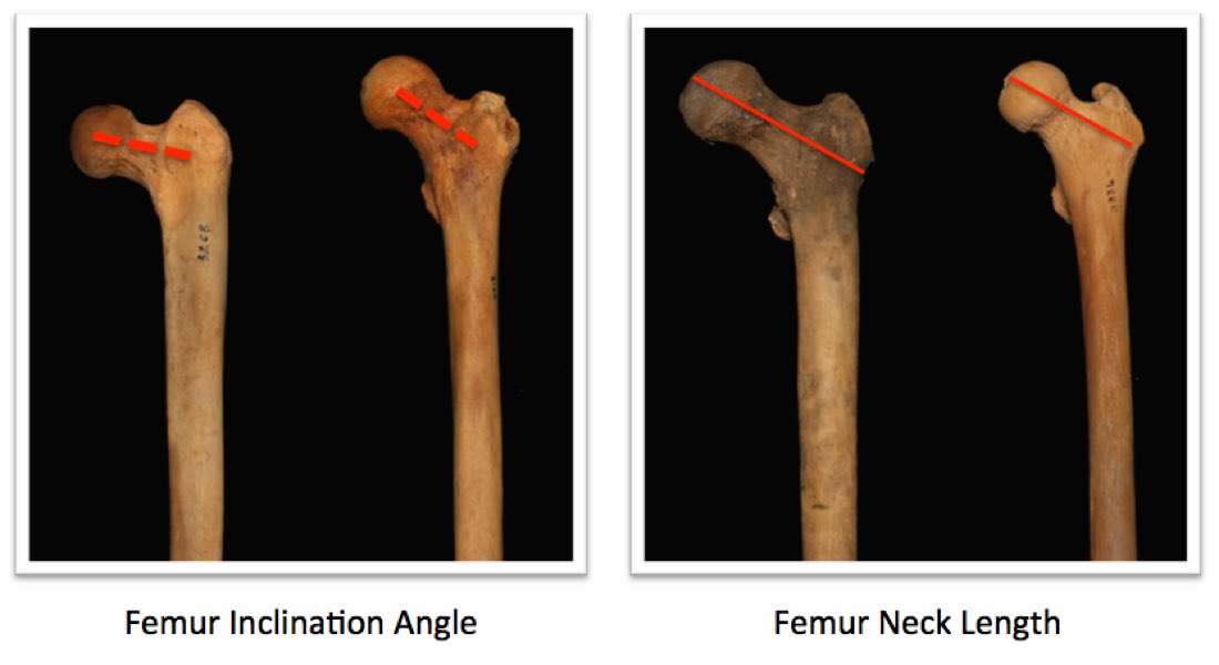Femur neck variations