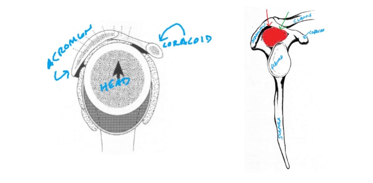 shoulder impingement essay shoulder impingement essay
