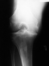 Knee Arthritis