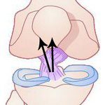 patellofemoral pain syndrome